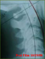 Chiropractor Atlanta Testimonial Low Back Pain Sciatic Nerve Pain
