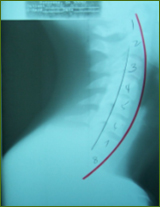 Chiropractor Atlanta Testimonial neck pain relief