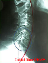 Chiropractor Atlanta Testimonial Chronic Cervical Kyphosis Chiropractor Atlanta Testimonial Chronic Cervical Kyphosis