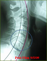 Chiropractor Atlanta Testimonial Chronic Cervical Kyphosis Chiropractor Atlanta Testimonial Chronic Cervical Kyphosis