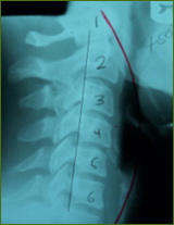 Chiropractor Atlanta Testimonial Auto Accident Chiropractor Atlanta Testimonial Auto Accident