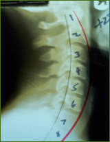 Chiropractor Atlanta Testimonial Auto Accident Chiropractor Atlanta Testimonial Auto Accident