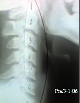 Chiropractor Atlanta Testimonial mid back pain relief Chiropractor Atlanta Testimonial mid back pain relief
