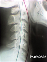 Chiropractor Atlanta Testimonial mid back pain relief Chiropractor Atlanta Testimonial mid back pain relief