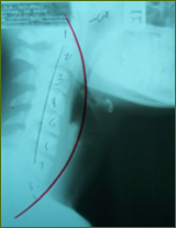 Chiropractor Atlanta Testimonial neck pain relief Chiropractor Atlanta Testimonial neck pain relief